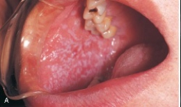 The classic appearance of what condition shown below is a pattern of interconnecting slender lines referred to as Wickham striae?   A) Lichen planus B) Linea alba C) Erythema multiforme D) Reiter syndrome