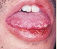 <strong>The onset of this condition is explosive. It is characterized by skin and mucosal lesions. The skin lesions are referred to as target, iris, or bull's eye lesions. The mucosal lesions affect the buccal mucosa, lips, and tongue and appear as superficial ulcerations. The lip lesions are ulcerated, encrusted, and bloody.   On the basis of this description, you suspect:</strong> A)lichen planus. B)erythema multiforme. C)contact dermatitis. D)SLE. <div style=padding-top: 35px> 