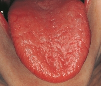 <strong>This patient has Sjögren syndrome and severe xerostomia.   Which clinical feature most appropriately describes the changes on the tongue in this patient?</strong> A)Dryness B)Candidiasis C)Loss of filiform and fungiform papillae D)Fissures <div style=padding-top: 35px> 