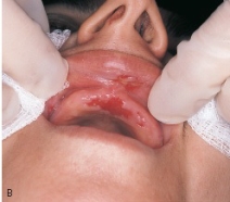 This patient presents with an intraepithelial bulla from breakdown of the cellular adhesion between epithelial cells. The bulla ruptured, resulting in a painful ulcer with itching.   The correct diagnosis for this progressive autoimmune disease is: A) pemphigus vulgaris. B) Reiter syndrome. C) aphthous ulcers. D) Langerhans cell disease.