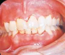 The gingivae shown are painful and erythematous. The interdental papillae appear as punched-out, necrotic, cratering areas. The overall sloughing of the necrotic tissue appears as a pseudomembrane over the tissues. The patient experiences a foul odor and metallic taste.   On the basis of these features, you suspect that this patient has: A) acute marginal gingivitis. B) primary herpes simplex infection. C) necrotizing ulcerative gingivitis. D) pseudomembranous candidiasis.