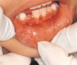The image shows an oral condyloma acuminatum presenting in a child.   The presence of condyloma acuminatum in a child suggests: A) hypersensitivity. B) genetic predisposition. C) sexual abuse. D) autoimmune disease.