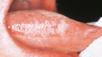 The most reliable method of diagnosis for this condition of the tongue is the isolation of the Epstein-Barr virus.   This condition is: A) white hairy tongue. B) hairy leukoplakia. C) mononucleosis. D) Kaposi sarcoma.