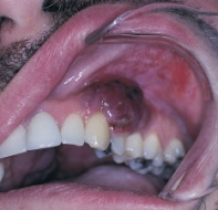 The patient is HIV seropositive. The most common intraoral locations for this type of lesion are the gingiva and palate. When diagnosed, this vascular lesion meets the criteria for the diagnosis of acquired immune deficiency syndrome (AIDS) .   What is the name of the vascular lesion that is seen in this image? A) Non-Hodgkin lymphoma B) Kaposi sarcoma C) Thrombocytopenia D) Hemangioma