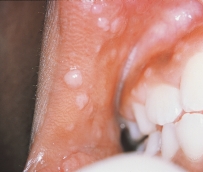 The lesions seen in this illustration are not commonly found in HIV-infected patients.   Which of the following are they most likely to be? A) Candidiasis B) Hairy leukoplakia C) Herpes simplex D) Heck disease