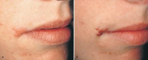 The vesicle cluster visible on the corner of this patient's vermilion border is also referred to as a cold sore or fever blister.   This is called: A) herpes labialis. B) primary herpes. C) aphthous ulcer. D) herpetic whitlow.