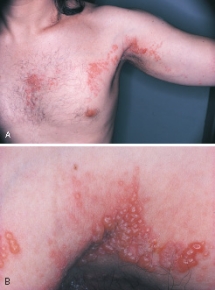 The unilateral eruption of vesicles along the distribution of a sensory nerve seen in this adult patient is characteristic of:   A) recurrent intraoral herpes simplex. B) minor aphthous ulcers. C) varicella-zoster or chickenpox. D) herpes zoster or shingles.