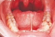 This patient exhibits an extensive adhesion of the tongue to the floor of the mouth caused by the short lingual frenum.   You suspect: A) ankyloglossia. B) frenectomy. C) lingual thyroid. D) total ankyloglossia.