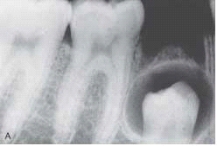 This unilocular radiolucency around the crown of an unerupted second premolar is most likely a:   A) normal developmental sac. B) dentigerous cyst. C) primordial cyst. D) lateral periodontal cyst.