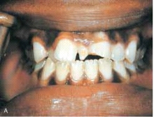 The supernumerary tooth in this illustration is:   A) a mesiodens. B) a dilaceration. C) the result of twinning. D) the result of gemination.