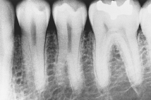 The developmental anomaly seen in this radiograph is:   A) taurodontism. B) mulberry molar. C) supernumerary roots on the mandibular premolars. D) dilaceration.