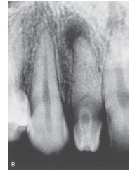 This radiograph clearly shows which developmental anomaly?   A) Dens in dente B) Periapical pathology (PAP)  C) Caries D) Open contacts