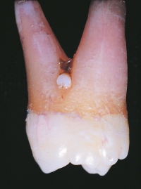 The projection of white material seen at the furcation area in this maxillary molar is a developmental anomaly.   You suspect: A) dens evaginatus. B) enamel pearl. C) supernumerary cusp. D) calculus.