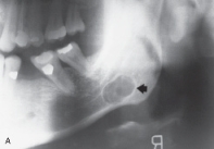 The pseudocyst seen in this radiograph is surrounded by salivary gland tissue.   It is a(n)  _____ bone cyst. A) simple B) Stafne C) traumatic D) aneurysmal