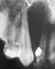 The pear-shaped radiolucency observed in this radiograph is most likely a _____ cyst.   A) radicular B) globulomaxillary C) lateral periodontal D) nasopalatine canal