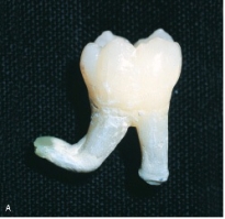 The deformity seen here with a bend in root apices is characteristic of:   A) dilaceration. B) gemination. C) fusion. D) concrescence.