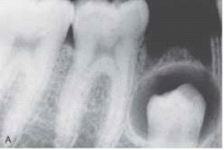 The cyst that appears in the bone in this radiograph surrounds the fully formed crown of an unerupted premolar.   The dental hygienist should refer to this as a(n)  _____ cyst. A) eruption B) follicular C) lateral periodontal D) primordial