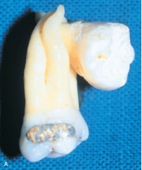 When two or more teeth are joined by cementum, as shown in this picture, it is known as:   A) concrescence. B) dilaceration. C) enamel pearl. D) gemination.