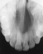 Periapical x-ray examination reveals a well-defined unilocular radiolucency located in the midline of the hard palate.   The diagnosis is _____ cyst. A) nasolabial B) globulomaxillary C) branchial cleft D) median palatine