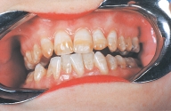 This patient is perfectly healthy, with no history of local or systemic infection or disease. All of the patient's teeth are caries free, as are all of the teeth of all of the patients who exhibit this defect.   This is characteristic of: A) fluorosis. B) Hutchinson incisors. C) a Turner tooth. D) attrition.