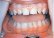 When counting the maxillary anterior teeth of this adolescent patient, it appears that five are present, if the large tooth is counted as one. A radiograph reveals that this large central tooth has two roots.   This tooth demonstrates: A) geminism. B) concrescence. C) dilaceration. D) fusion.