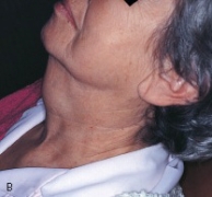 This enlargement on the lateral neck of this patient has been present for months and is slowly increasing in size. It is painless and feels soft.   Histologic examination shows this to be an epithelium-lined sac filled with clear, yellow fluid. It is a _____ cyst. A) thyroglossal duct B) branchial C) median palatine D) globulomaxillary
