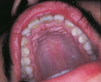 This patient exhibits an accessory cusp located in the cingulum of the maxillary right lateral permanent incisor.   This can be diagnosed as a: A) talon cusp. B) dens in dente. C) taurodontism. D) dens evaginatus.