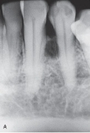 The radiograph of this patient exhibits a biloculated, well-defined radiolucency lateral to the tooth root. It is asymptomatic.   This is a _____ cyst. A) residual B) follicular C) lateral periodontal D) primordial