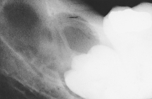 The name of this benign tumor that is slow growing but locally aggressive and derived in association with an impacted tooth and dentigerous cyst is:   A) calcifying odontogenic cyst. B) odontogenic myxoma. C) compound odontoma. D) ameloblastoma.