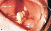 This benign tumor of fat cells that clinically appears as a yellowish mass surfaced by a thin layer of epithelium is referred to as a:   A) chondroma. B) rhabdomyosarcoma. C) lipoma. D) lymphoma.