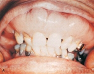 This 74-year-old patient presents with an enlargement of the maxilla, pain, and a chief complaint that his dentures no longer fit. Radiographic examination reveals a patchy radiolucency and radiopacity that resembles cotton wool.   This is indicative of what disease of bone? A) Osteomalacia B) Paget disease of bone C) Fibrous dysplasia D) Florid cemento-osseous dysplasia