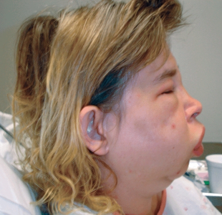 <strong>The nurse enters a client's room and observes the manifestations shown below.What action should the nurse take first?  </strong> A) Prepare to administer diphenhydramine (Benadryl). B) Prepare to administer epinephrine. C) Assess the client's respiratory status. D) Get a full set of vital signs. <div style=padding-top: 35px> 