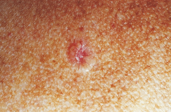 The nurse assessing a client notices a lesion on the skin as shown in the photograph below.For which diagnostic test does the nurse prepare the client?   A)  Punch skin biopsy B)  Viral cultures C)  Wood's lamp examination D)  Diascopy