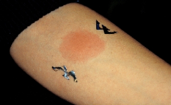 A client has a tuberculin skin test as a pre-employment physical requirement.Which statement by the nurse is best made to the client who has the test result seen in the photograph below?   A)   Your PPD is negative. No further follow-up is necessary.  B)   You will need to have a second PPD.  C)   You will need to have titers drawn.  D)   You will need further testing. 