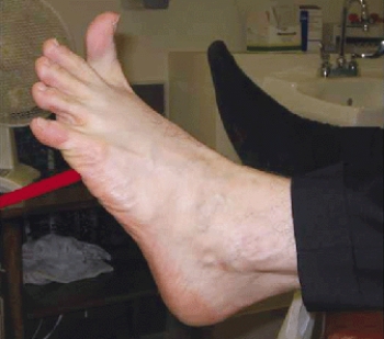 <strong>On assessment of the left plantar reflexes of an adult client,the nurse notes the response shown in the photograph below.What action does the nurse take after assessing this new finding?  </strong> A) Relay this abnormal finding to other members of the health care team. B) Anticipate the need for cerebral angiography to determine the cause. C) Examine the family history for a potential genetic disorder. D) Document the finding and continue the assessment. <div style=padding-top: 35px> 