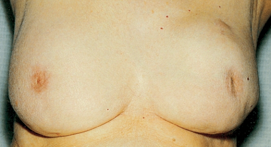 <strong>The clinic nurse is preparing a client for a physical and breast examination.The nurse notes the client's breast appears as shown in the photograph below.Which action by the nurse takes priority?  </strong> A) Continue preparations and note the finding in the client's chart. B) Ask the client how long this problem has been present. C) Alert the health care provider and prepare to order a mammogram. D) Question the client about routine drug and alcohol intake. <div style=padding-top: 35px> 