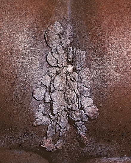 <strong>The nurse assesses a client and finds the manifestation shown in the photograph.Which drug does the nurse prepare to administer to the client?  </strong> A) Doxycycline (Vibramycin) B) Ceftriaxone (Rocephin) C) Acyclovir (Zovirax) D) Podophyllin (Pododerm) <div style=padding-top: 35px> 