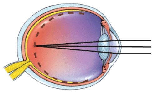 What is this a picture of?   A) Nearsightedness B) Farsightedness C) Astigmatism D) Normal vision