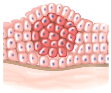 The tumor in the illustration is:   A) malignant. B) metastatic. C) benign. D) exhibiting contact inhibition.