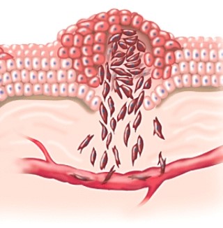 This process is called:   A) angiogenesis. B) metastasis. C) apoptosis. D) oncogenesis.