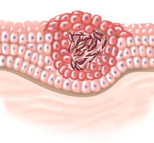 This process is called:   A) hyperplasia. B) malignant. C) apoptosis. D) in situ.