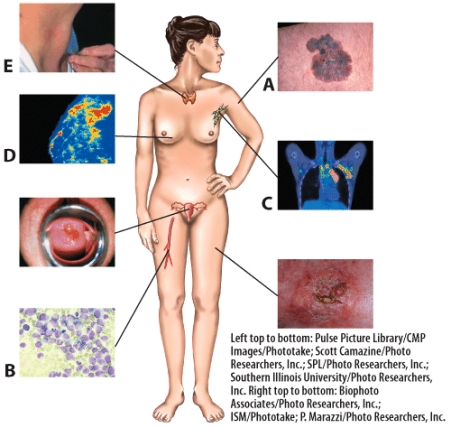 Lymphoma is indicated by which letter in the picture?   A) A B) B C) C D) D