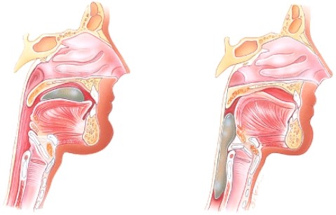Which stage of swallowing is shown here?   A) Voluntary stage B) Pharyngeal stage C) Esophageal stage D) Pyloric stage