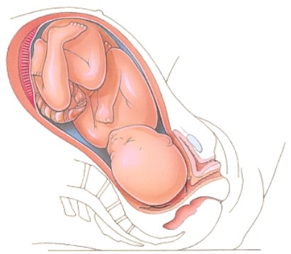 Which stage of labor is depicted here?   A) Dilation B) Expulsion C) Placental D) Birth