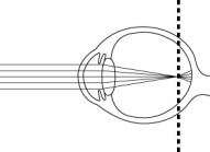   -The figure above is a diagram of an abnormal eye that would result in vision problems. A person with this condition would be considered farsighted and would require convex lenses in order to see objects in the distance.