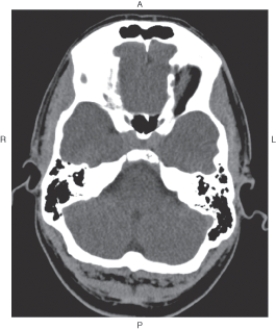 The figure below illustrates which of the following imaging planes?   A)  Axial B)  Coronal C)  Sagittal D)  Oblique
