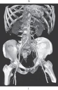 The figure below is an example of which of the following?   A)  Multiplanar reformation B)  Shaded surface display C)  Maximum intensity projection D)  Volume rendering