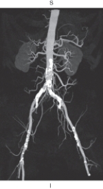 The figure below is an example of which of the following?   A)  Multiplanar reformation B)  Shaded surface display C)  Maximum intensity projection D)  Volume rendering