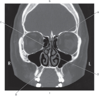 Refer to the figure below of a coronal CT of the ethmoid bone.    -Which arrow points to the vomer? A)  A B)  B C)  C D)  D