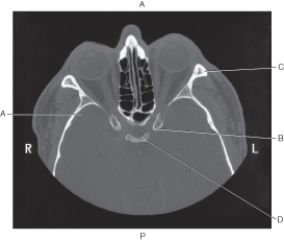 Refer to the figure below of an axial CT of the orbit.    -Which arrow points to the dorsum sellae? A)  A B)  B C)  C D)  D